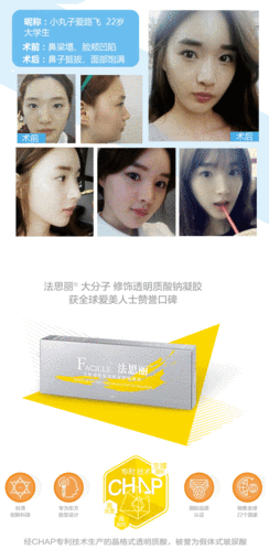 广州法思丽玻尿酸1ml 高浓度 高粘性立体轮廓塑形 塑造精致五官 正规