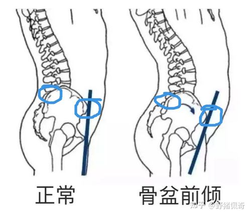 骨盆前倾带你了解