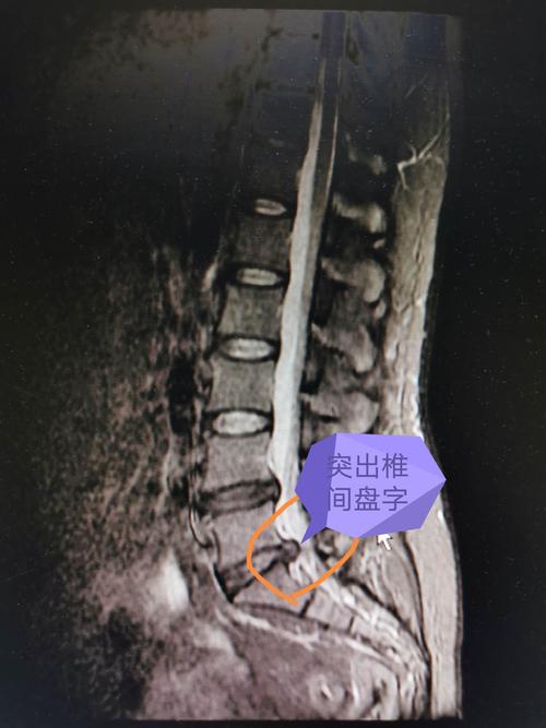 mri示椎间盘突出,硬膜囊受压.