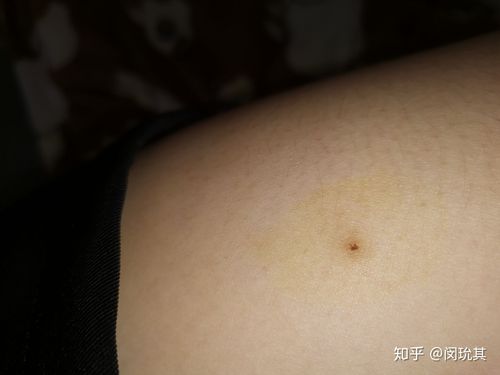 背上长了一个红色的疙瘩,不小心挤破了之后挤出来一个