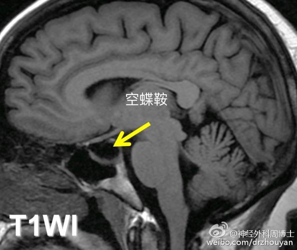 【临床病例分析】鞍区rathke囊肿的诊断及治疗方案