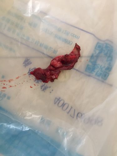 切下来的输卵管,剖开可见孕囊样组织.