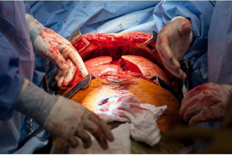 肺纤维化手术开腹图片