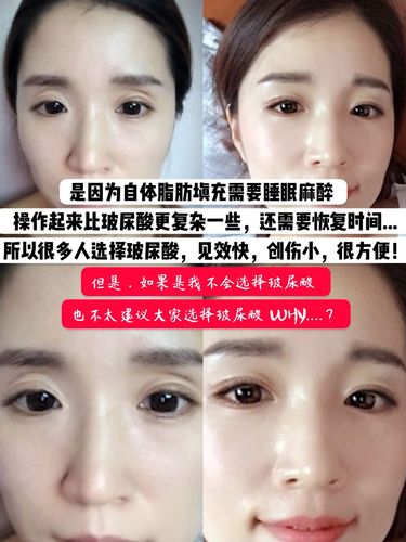 填充丰眼窝的材料有两种 "玻尿酸 and 自体脂肪" - 是因为自体脂肪