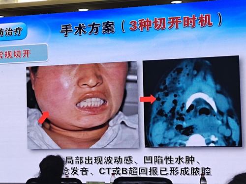 口腔颌面间隙感染