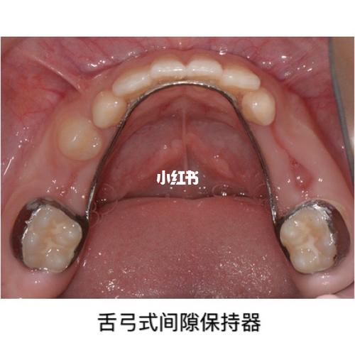 儿童间隙保持器的种类的选择6015_牙齿保护_口腔