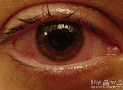 眼睛葡萄膜炎属于什么
