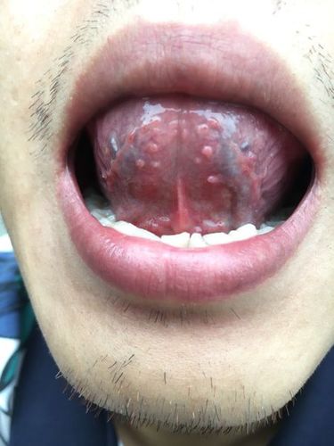 医生,大神帮我看看我这是不是口腔尖锐湿疣