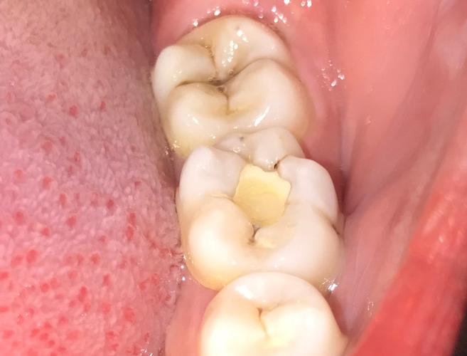 根管治疗后一定要做牙套吗?