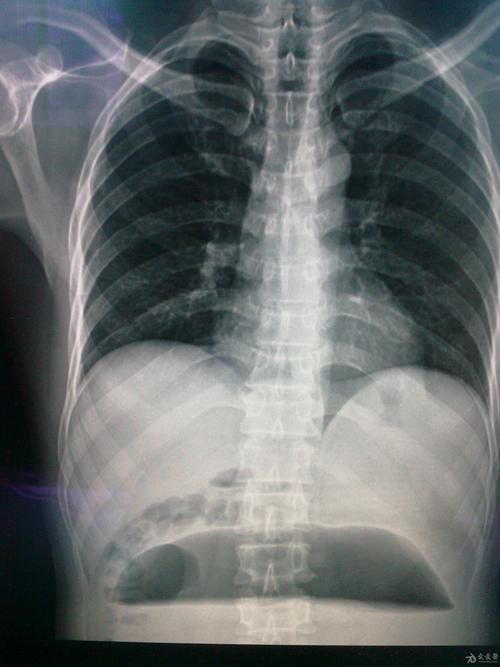 腹部一长液气平面