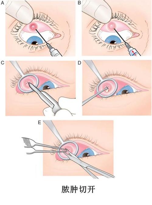 如早期麦粒肿采取上述措施无好转倾向或出现以下症状者应及时就医.