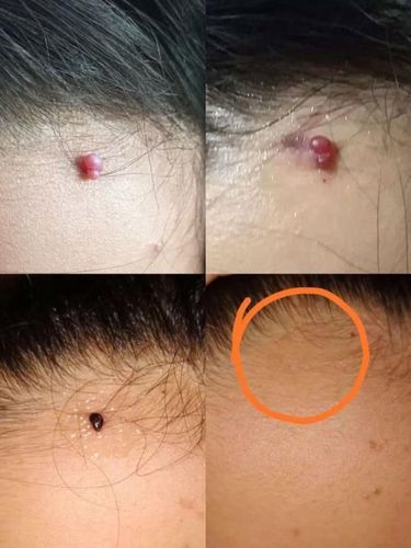 血管瘤特殊类型--化脓性肉芽肿的无痕治疗