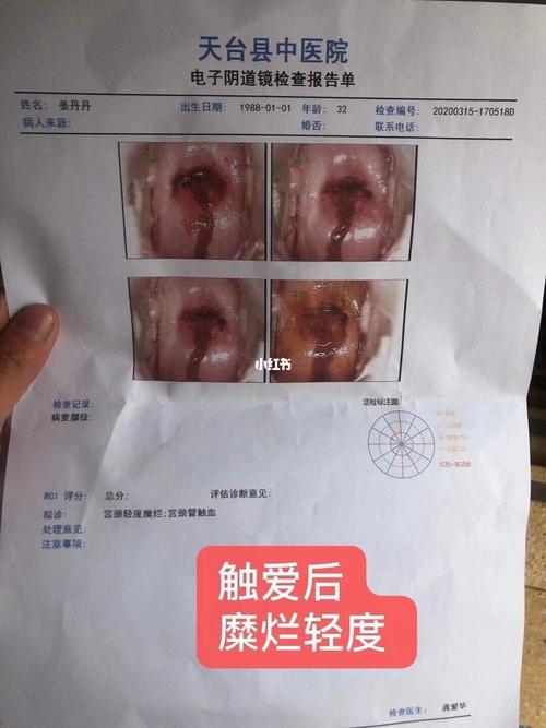 宫颈糜烂_医疗健康_医疗健康其他