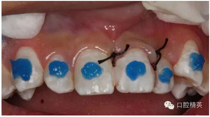 光固化树脂 唇弓夹板固定
