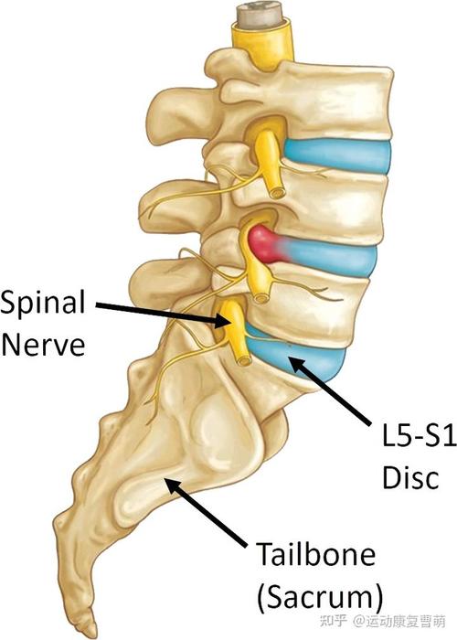 l5/s1腰椎轻度突出,以后还可以跑步吗?