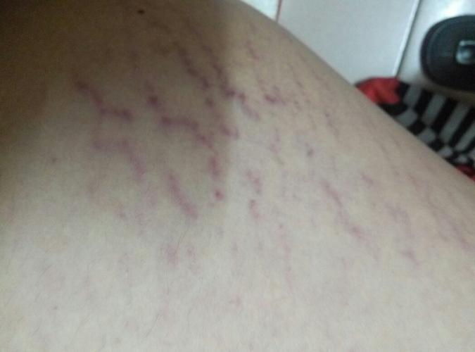 大腿内测长了这些有人说是萎缩纹,怎么办