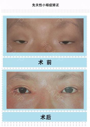 正经干货医学专业科普,什么是先天小眼症#91小眼症