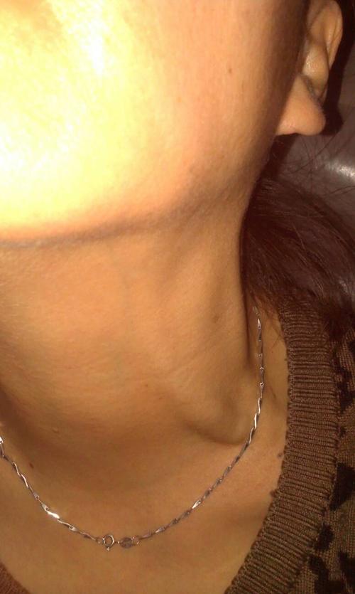 脖子左侧血管粗,左边脑袋发闷,请问是什么原因.求高手