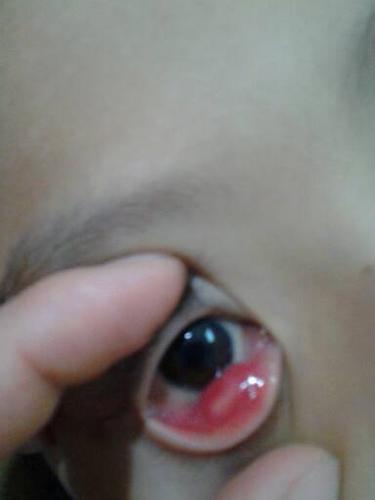 问:九岁孩子结膜炎,长期用眼药水,现在又有麦粒肿,再长期用眼药水可以