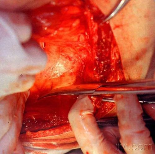 肾移植手术步骤的图片