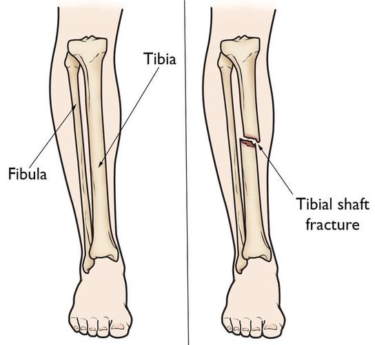 胫骨(tibia),腓骨(fibula)示意图