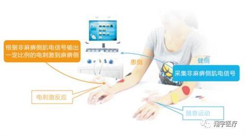 国际最新卒中指南——肌电生物反馈疗法