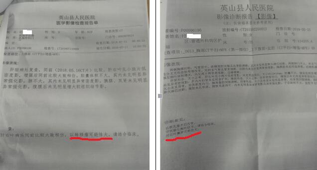 (付女士ct检查,左显示乳腺癌术后肝转移瘤,右显示肝囊肿)