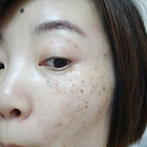 药水点斑我算是成功了吗,希望不会反黑72_美妆