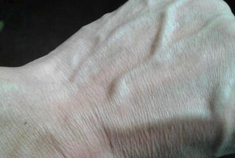 手上青筋明显和没有青筋的人,哪种更健康?是什么原因造成的?