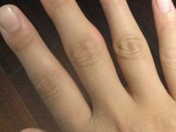 手骨关节炎多久能治愈