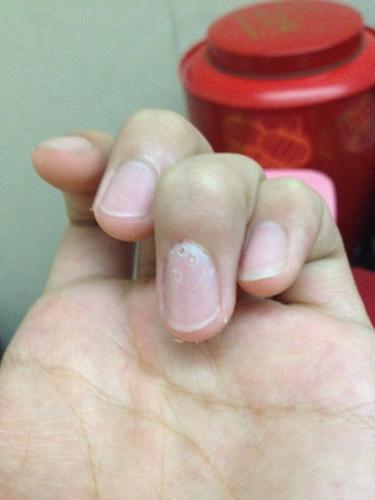 指甲上就出现了洞,用牙签轻轻插进那个破洞里很痛,怎么办,是缺钙吗