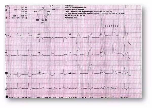 心电图st段抬高还可能是这些病第2期