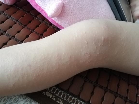 急急急,宝宝得了沙土性皮炎越来越严重,擦药喝药都没用