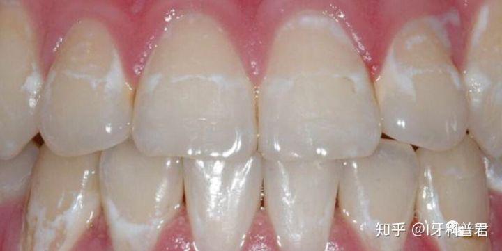 牙齿矫正会导致牙釉质脱矿?该怎么解决?