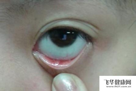 外麦粒肿会有引发患者畏寒和发烧的问题出现,而内麦粒肿会有眼睑脓肿