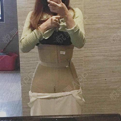 现在是腰腹环吸的第二周过去了,上周去拆线了,伤口还.吸脂_悦美整形