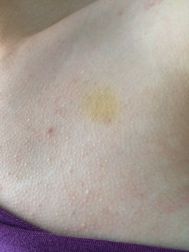 突然有的黄斑 长黄斑的原因有什么?会怎么样?