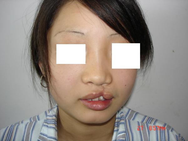 (原创)唇裂2期和腭裂手术一病例