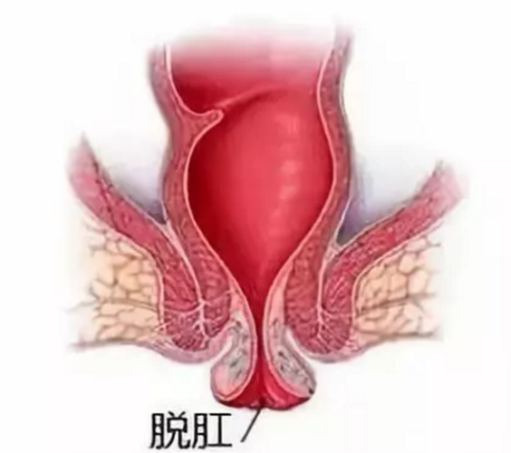 青海东大肛肠医院:脱肛是什么?你以为是痔疮吗?