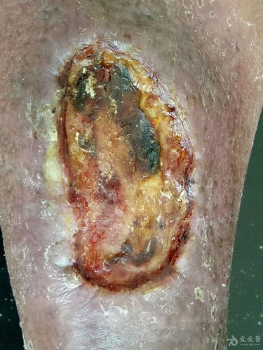 2016年皮肤版有奖病例猜答(10)答案:坏疽性脓皮病