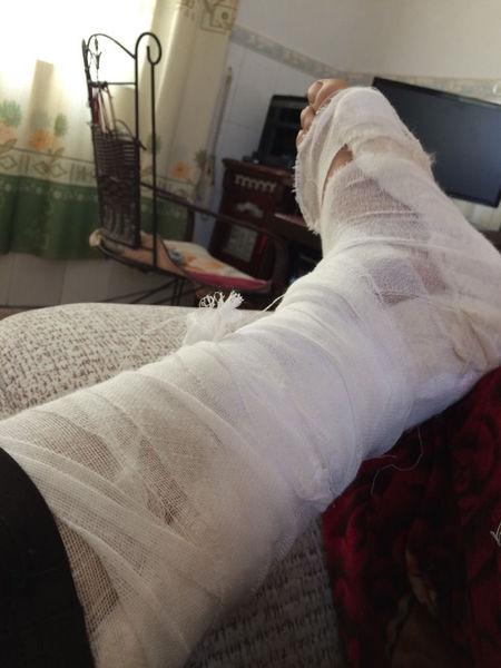 男15 脚的长肌短肌 被砍断 手术接好了 打了石膏 会不会有后遗症?