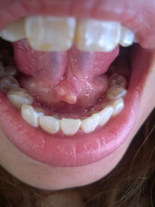 昨天发现自己舌头下面长了两个米粒大的白色