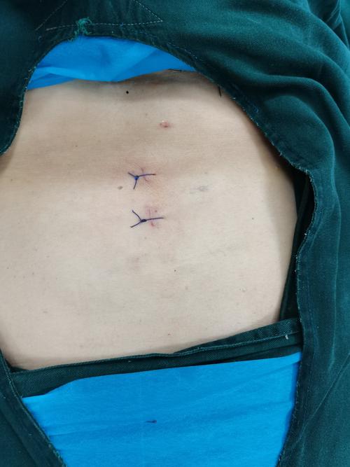 太康县首例ube微创技术治疗腰椎管狭窄症