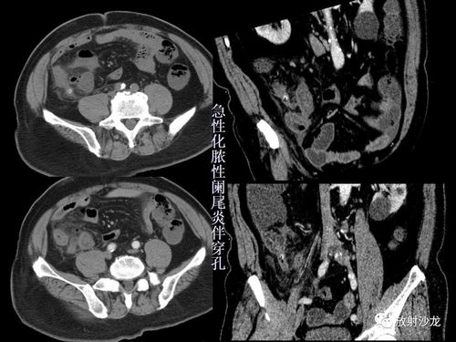 开课了急性阑尾炎的ct诊断及鉴别诊断