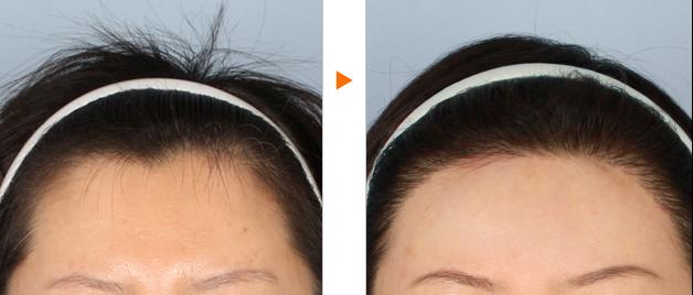 听说有发际线移植,那什么是发际线移植