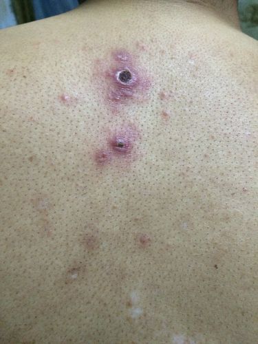 有人知道这是什么病吗?开始时痘痘很痒,抓破了后中间就结痂了