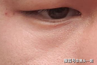 眼角下鼻子旁的小白颗粒是什么呀毛周角化鸡皮肤