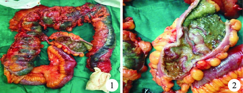 急性乙状结肠癌性梗阻致近端全结肠,部分小肠坏死1例报道