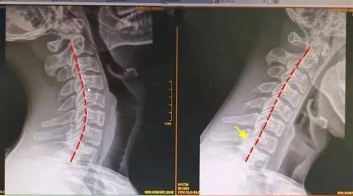 颈椎曲度变直拿什么拯救你我的颈椎