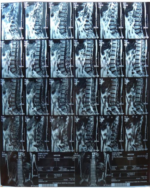 老爸爸最近几个星期右侧屁股疼痛,平躺和趴着不疼,最近做了核磁共振